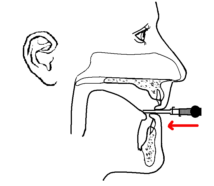 Embouchure reed in